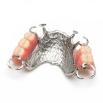Cast Partial Denture (CPD)