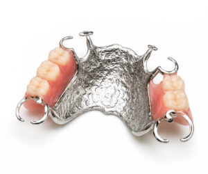 Cast Partial Denture (CPD)