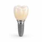 Implant Crown (Zirconia / PFM)
