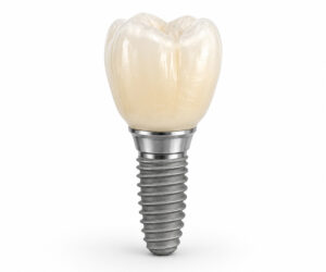 Implant Crown (Zirconia / PFM)